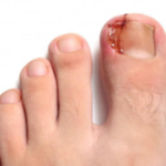 Ingrown Toenail Removal Near Me Stops Infection Risks Early