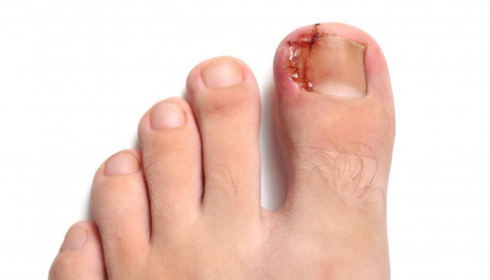 ingrown toenail removal